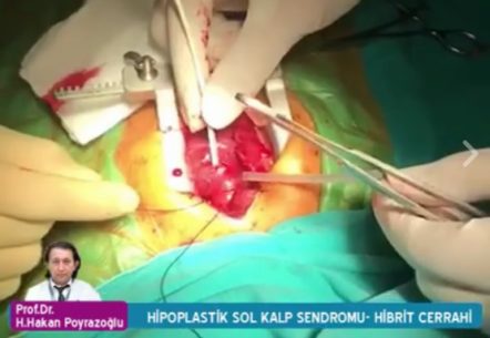 Başarılı Bir Hipoplastik Sol Kalp Sendromu